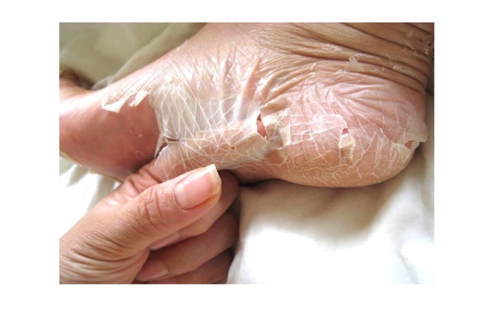 ما تفسير ازالة الجلد الميت في المنام لابن سيرين؟