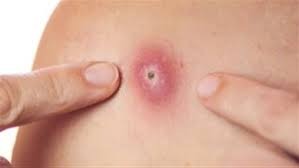 ما تفسير اخراج القيح في المنام لابن سيرين؟