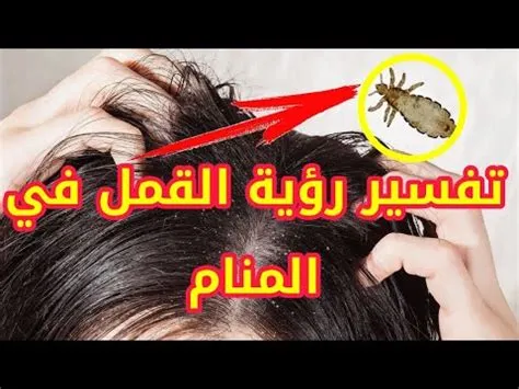 أهم تفسيرات رؤية القمل في المنام في الرأس لابن سيرين