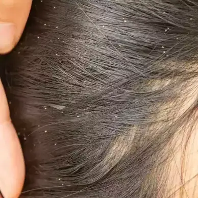 تأويلات ابن سيرين لرؤية القمل الاصفر في المنام