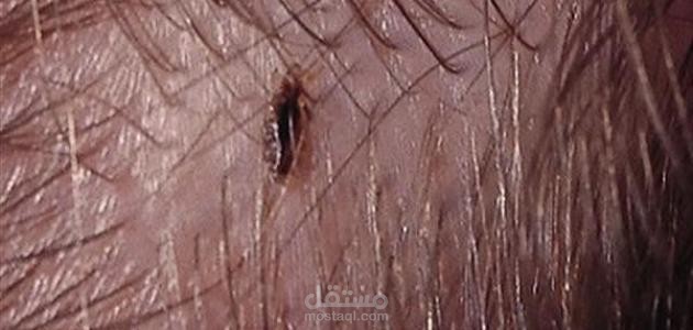اعرف أكثر عن تفسير رؤية القمل في المنام العصيمي