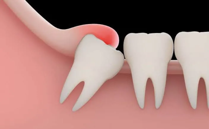 أهم تفسيرات الأضراس في المنام لابن سيرين وكبار المفسرين